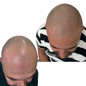 micro scalp camuflaje de pelo