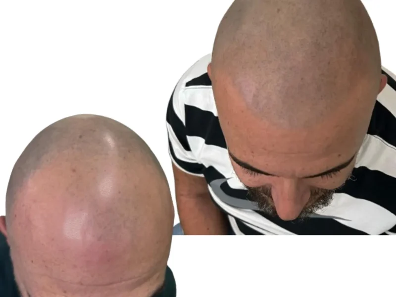 micro scalp camuflaje de pelo